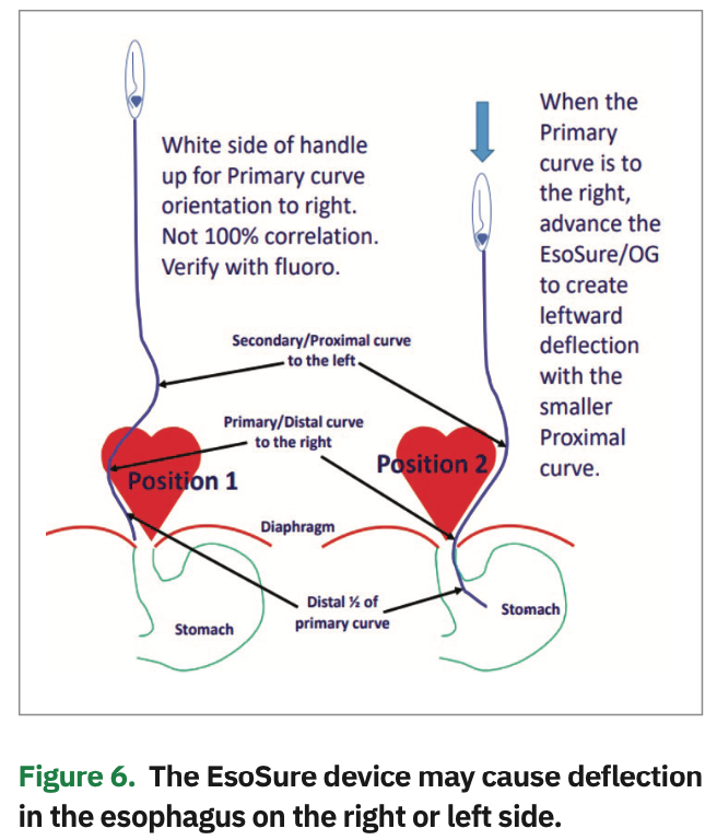 Mechanical Deviation of the Esophagus During Atrial Fibrillation